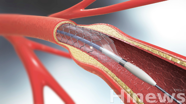 3세대 스텐트 시술 환자는 이중 항혈소판제를 3~6개월만 투여해도 12개월 투여와 효과와 안전성이 비슷하며, 장기 투여는 출혈 위험만 높인다. (사진 제공=클립아트코리아)