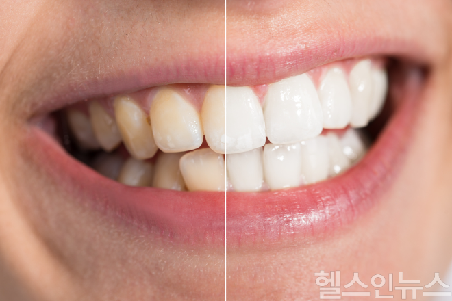 치아 표면의 미세한 구멍 사이로 음식물의 색소가 스며들면 변색이 일어나기 쉬우므로 식후 관리가 중요하다. (이미지 제공=클립아트코리아)