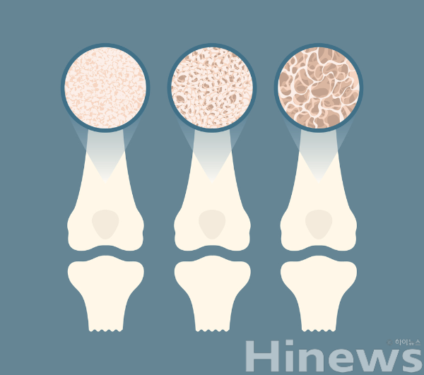골다공증은 초기 증상 없이 뼈가 약해져 골절 위험이 높아 조기 검진과 생활 관리가 필수다. (사진 제공=클립아트코리아)