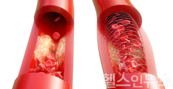 고혈압 유전 위험이 높으면 발병이 8년 빨라지고 최대 2.4배 증가하지만, 꾸준한 운동으로 위험을 크게 낮출 수 있다. (사진 제공=클립아트코리아)