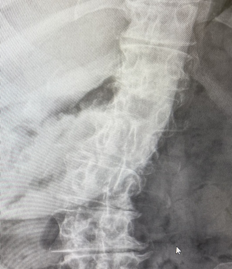 환자의 수술 전 전후방 X-ray 이미지