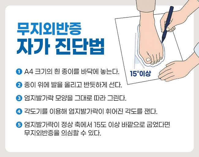 무지외반증 자가 진단법 <사진=힘찬병원 제공>