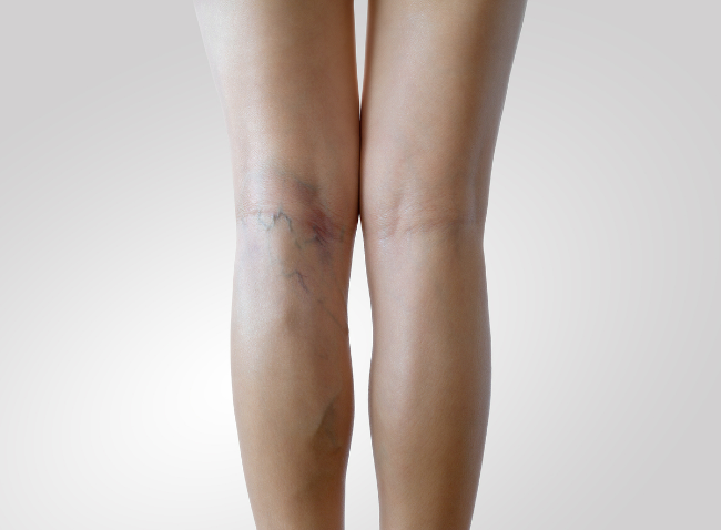 하지정맥류는 다리 정맥 속에서 피가 거꾸로 흐르지 않도록 막아주는 판막이 약해져 혈액이 아래에 고이면서 혈관이 늘어나고 튀어나오는 질환이다. <사진=클립아트코리아 제공>