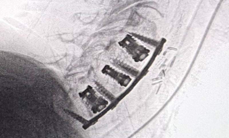 블루엑스-C를 삽입한 환자의 수술 후 경추 측면 X-ray 이미지
