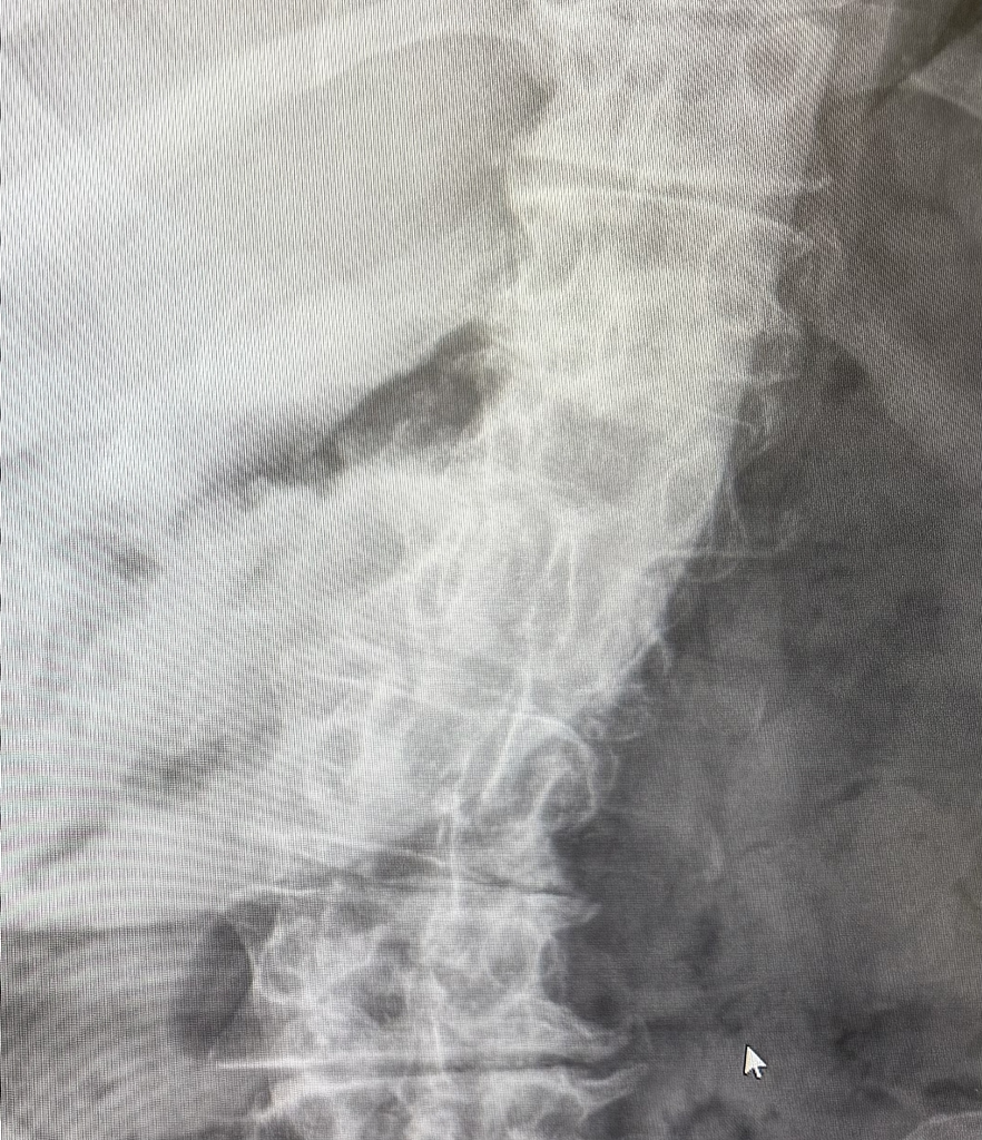 환자의 수술 전 전후방 X-ray 이미지