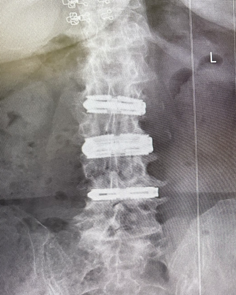 환자의 수술 후 전후방 X-ray 이미지