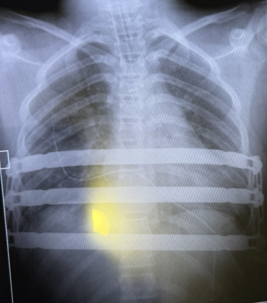 팩투스(Pectus) 수술 후 촬영한 흉부 X-ray 영상 이미지