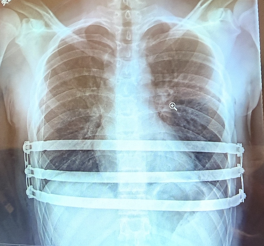 자로주스키 박사가 팩투스(Pectus) 수술을 집도 한 후 촬영한 흉부 X-ray 영상 이미지
