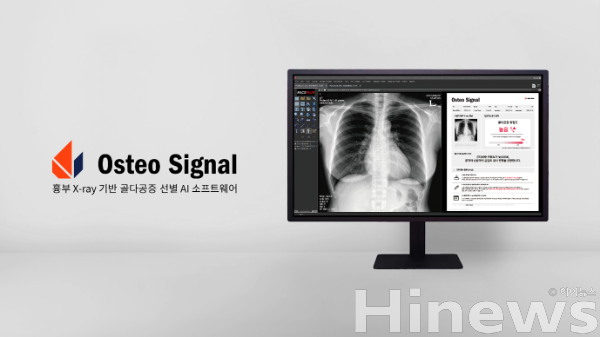 프로메디우스, 흉부 X-ray 골다공증 AI 신의료기술 선정 - 뉴스 썸네일 이미지