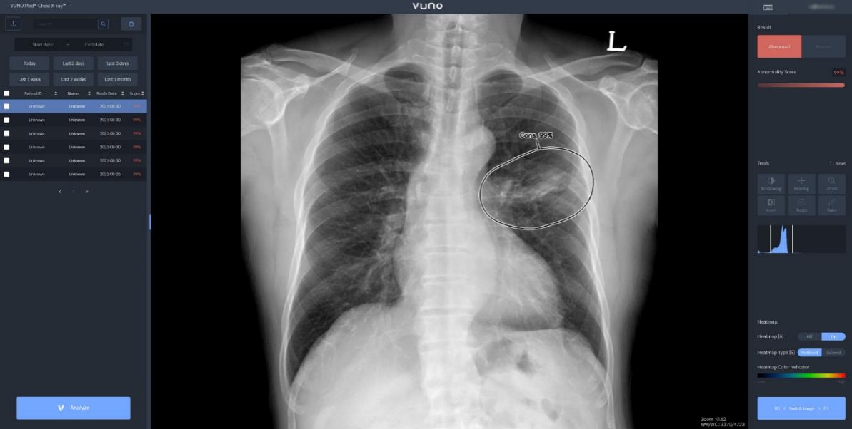 뷰노메드 체스트 엑스레이(VUNO Med-Chest X-Ray) 운영화면 예시.(사진=뷰노 제공)
